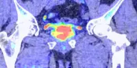 New Prostate Cancer Epigenetic Markers have been Discovered