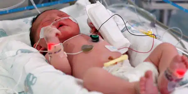 Preterm babies do not habituate to repeated pain