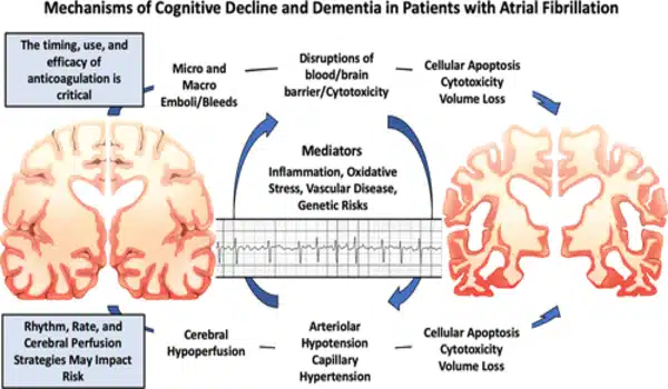 Incident atrial fibrillation appears to heighten dementia risk