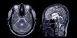 Children with ADHD have Different Brains, which Researchers can Demonstrate Using MRI