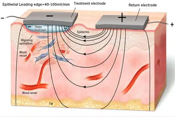 How electricity can heal wounds three times as fast