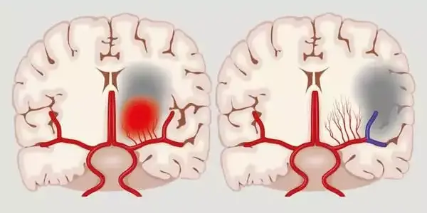 Potential causality between blood clot factors and migraine with aura