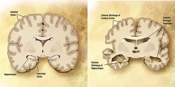 Neuroscientists identify cells especially vulnerable to Alzheimer's