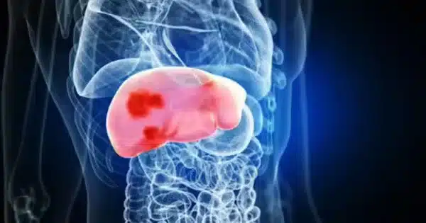 Novel AI blood test detects liver cancer