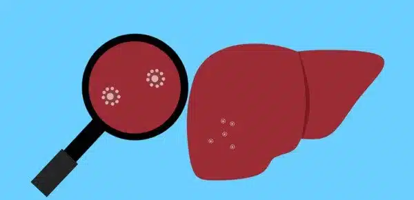 In Advanced Non-alcoholic Fatty Liver Disease, potential new targets have been identified