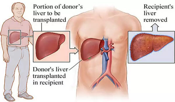 Living donor transplantation offers a safe alternative for liver transplant patients