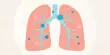 A Form of Allergy Drug may aid in the Treatment of Lung Cancer
