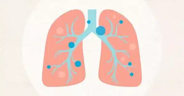 A Form of Allergy Drug may aid in the Treatment of Lung Cancer