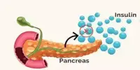 Insulin Resistance has been linked to Pancreatic Cancer