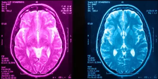 Distinct brain activity triggered by memories of trauma