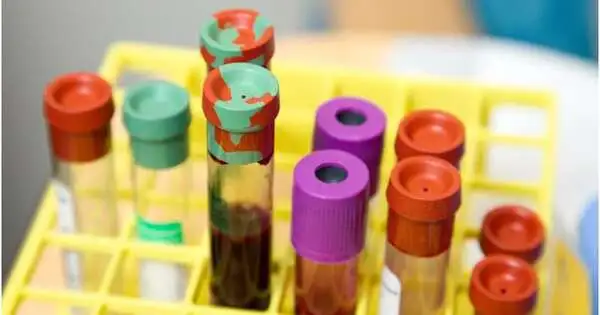 A Blood Test can identify the Advanced Prostate Cancer’s Neuroendocrine Subtype