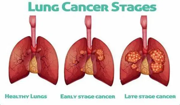 How one type of lung cancer can transform into another