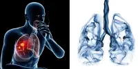 How may One Type of Lung Cancer Turn into Another?